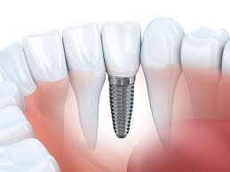 dental implants kota damansara